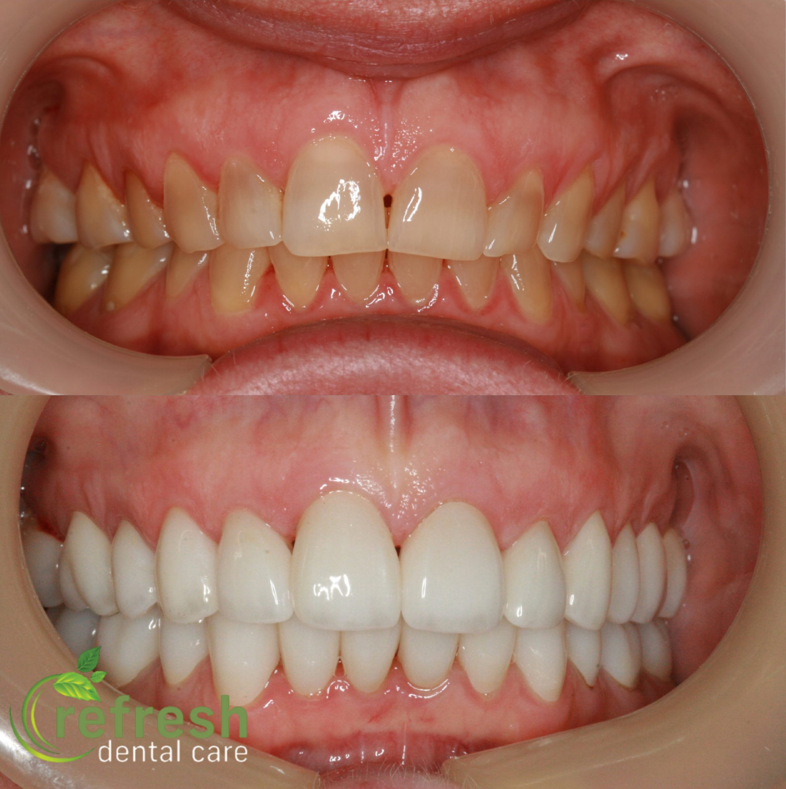 crowns and veneers new