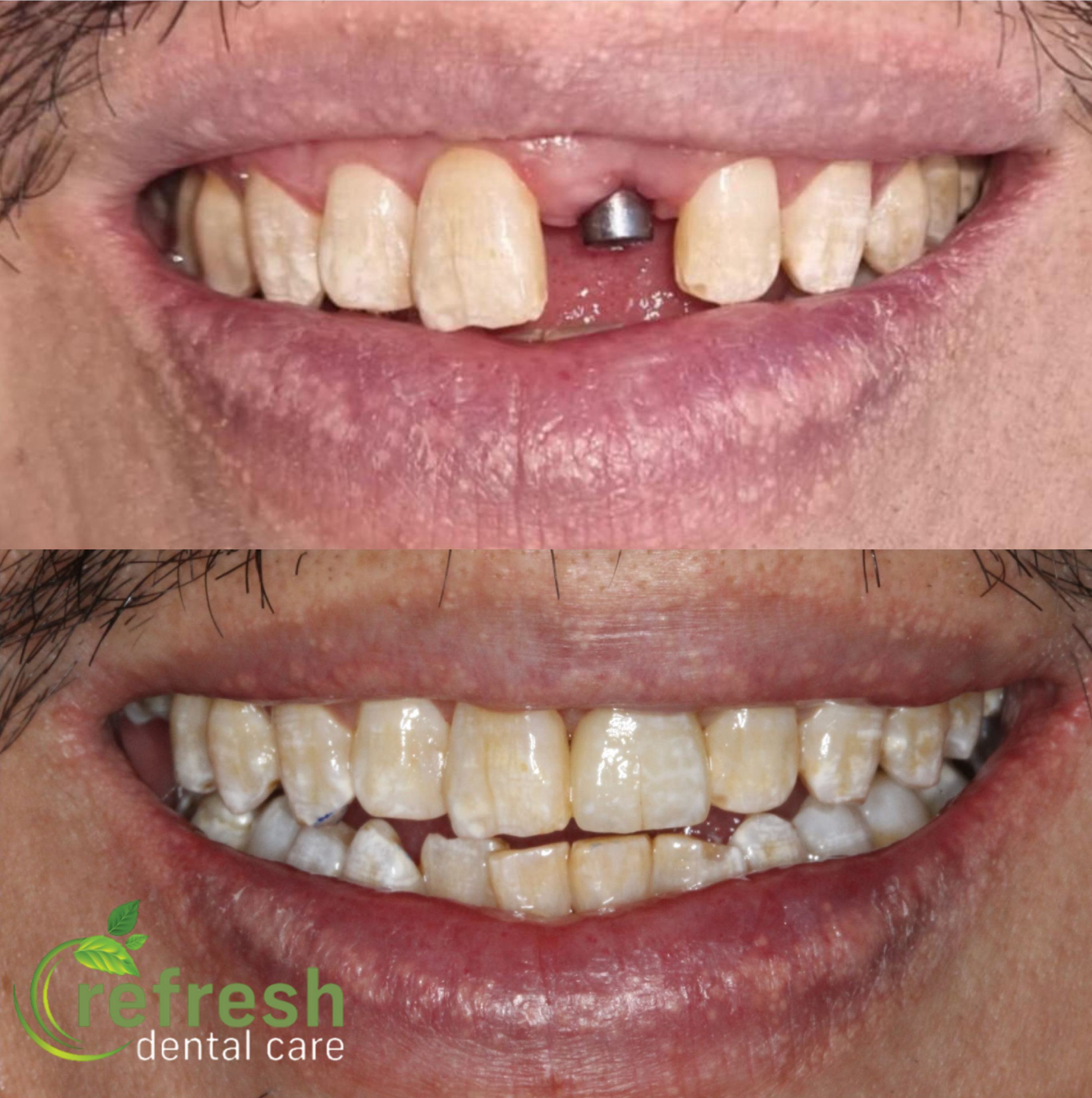 dental implant new