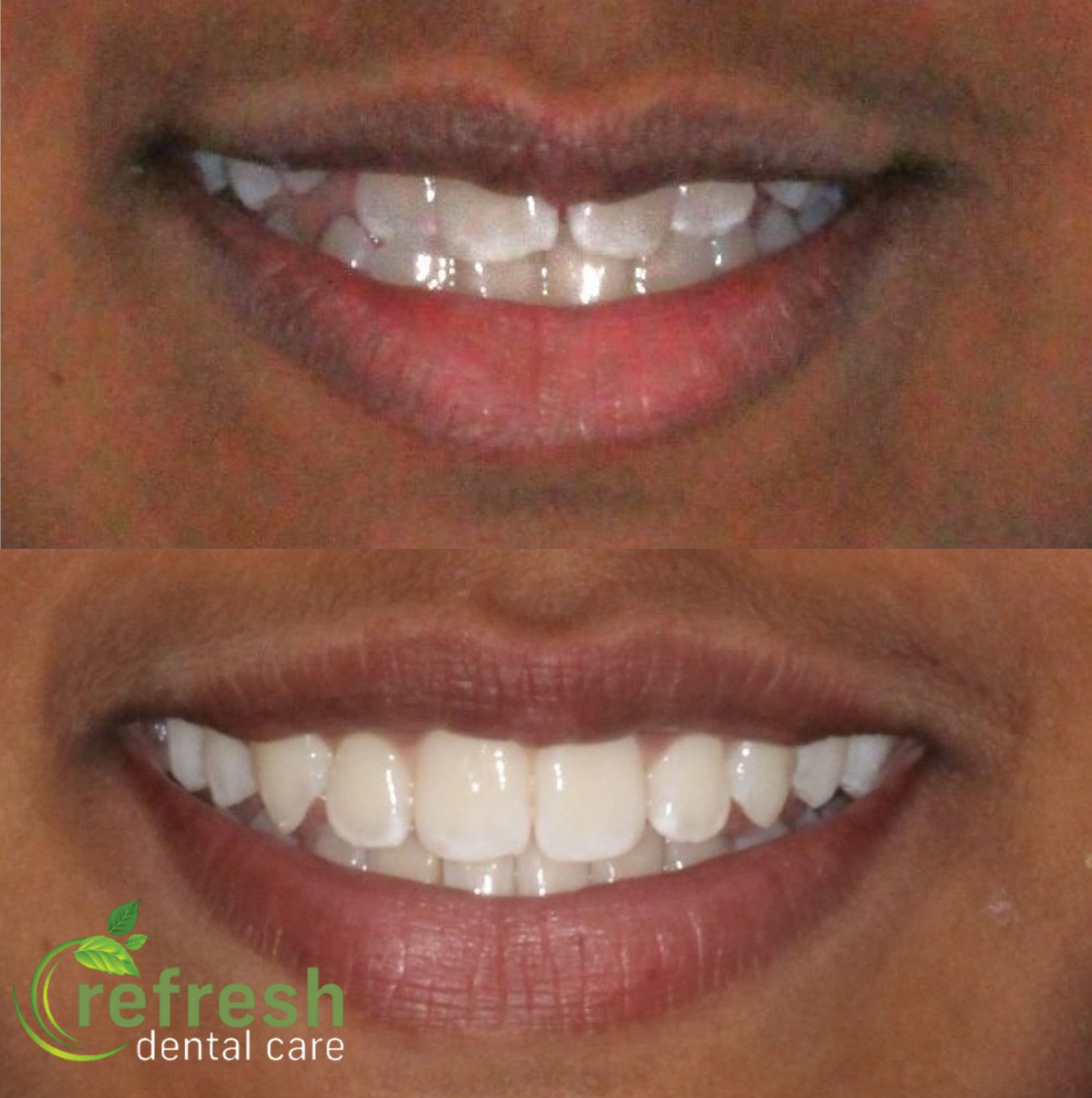 expander invisalign whitening new