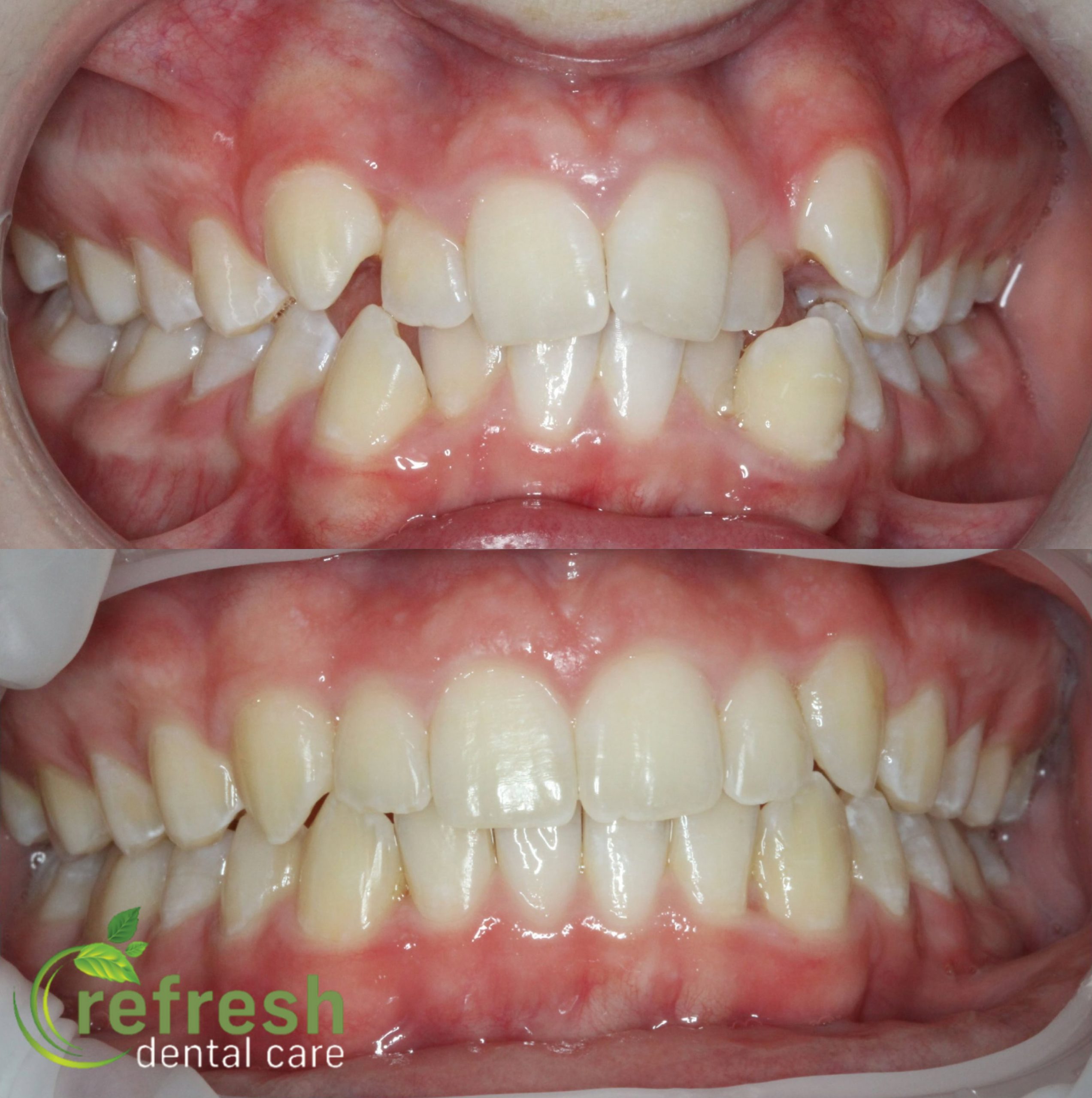 fixed braces new