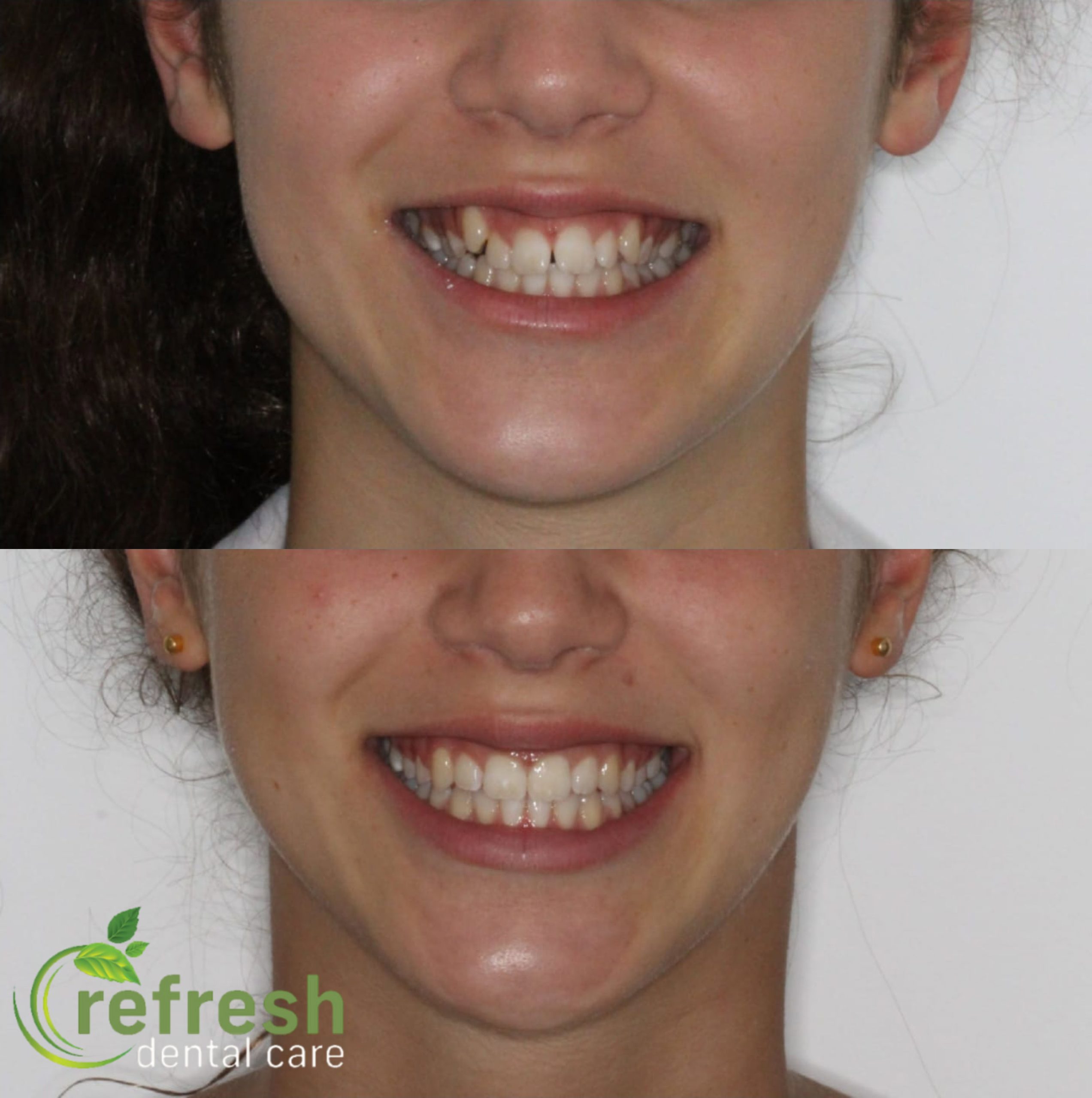 invisalign new