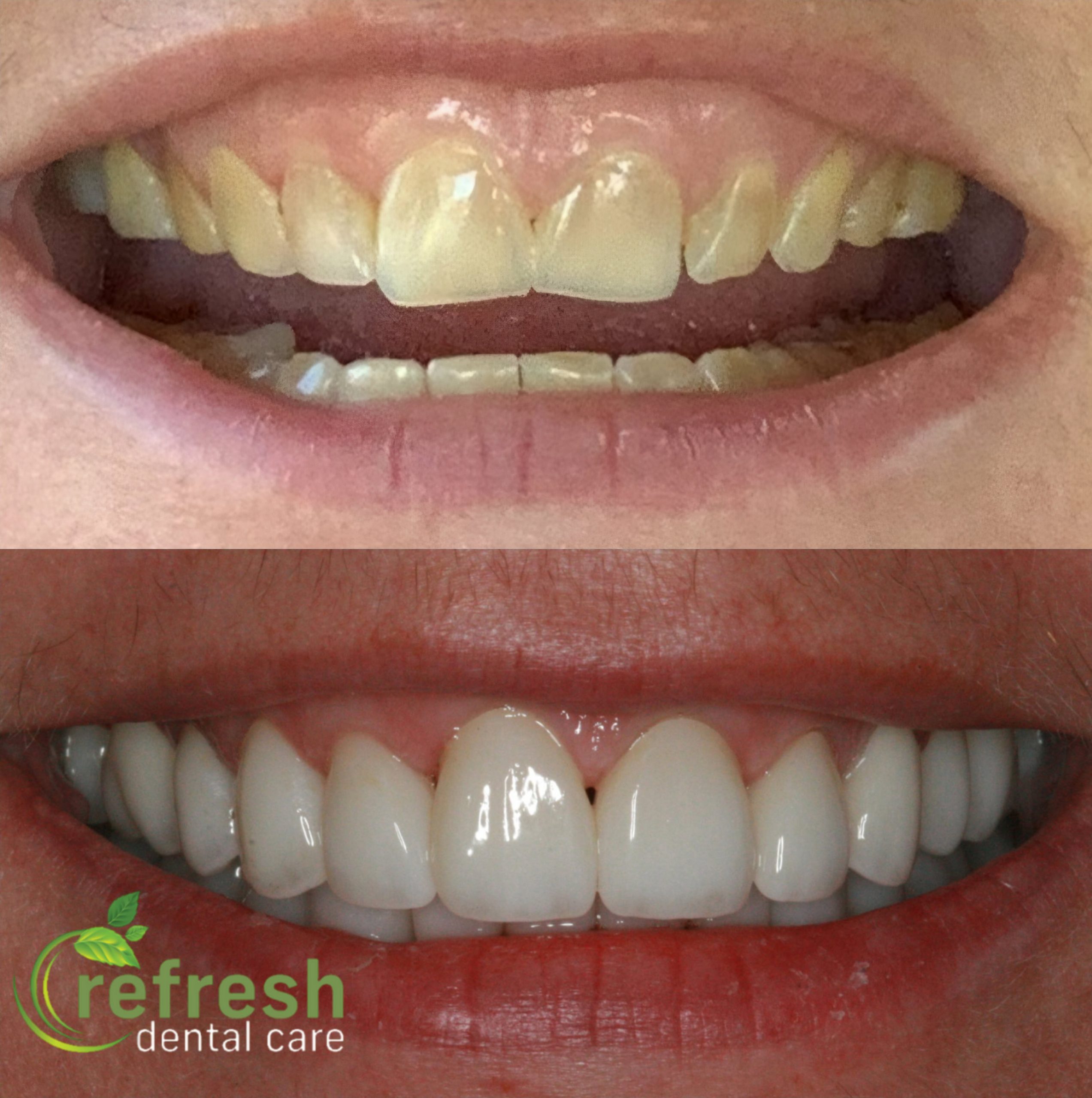 smile makeover new